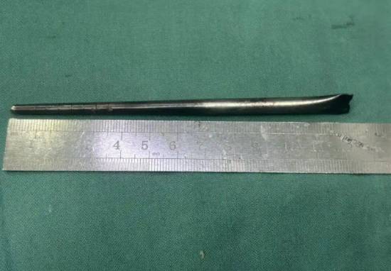 男子误吞12厘米筷子忍了8年才取出 网友：是个狠人